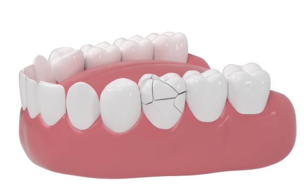 Understanding Tiny Cracks: Navigating the World of Minor Tooth Fractures