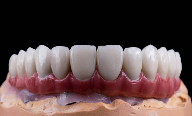 All About Ceramic Tooth Caps: Cost, types and advantages
