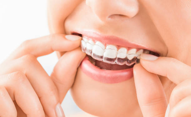 Braces vs Aligners: Let’s Find Your Perfect Fit