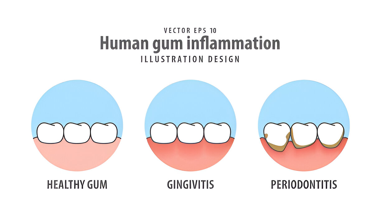 Do Non-Rigid Partials Reduce Gum Irritation Long-Term?