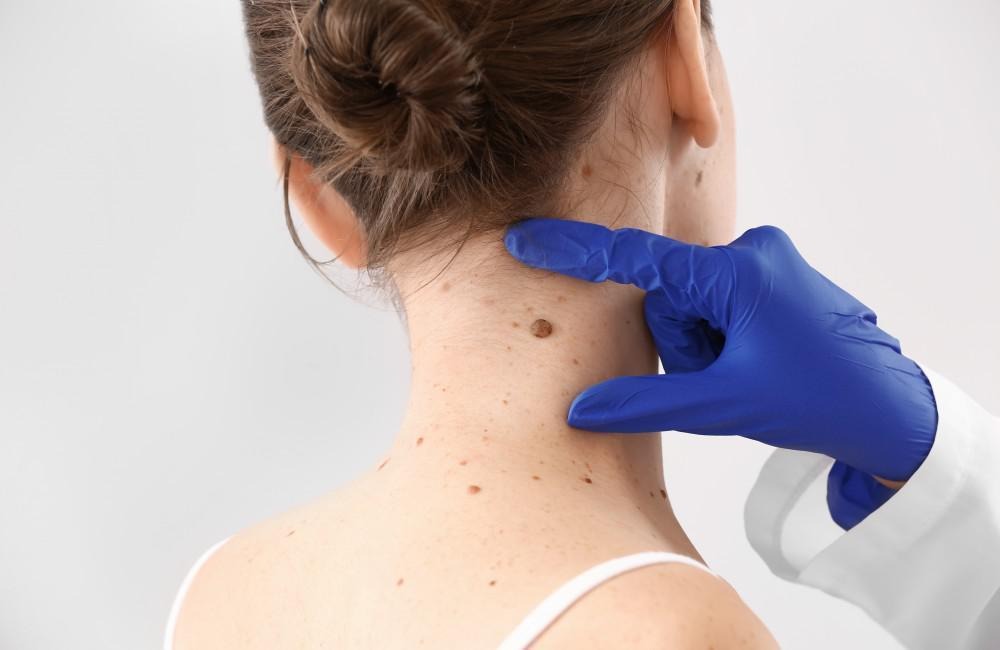 Effective Skin Tag Removal Treatments for Sensitive Skin