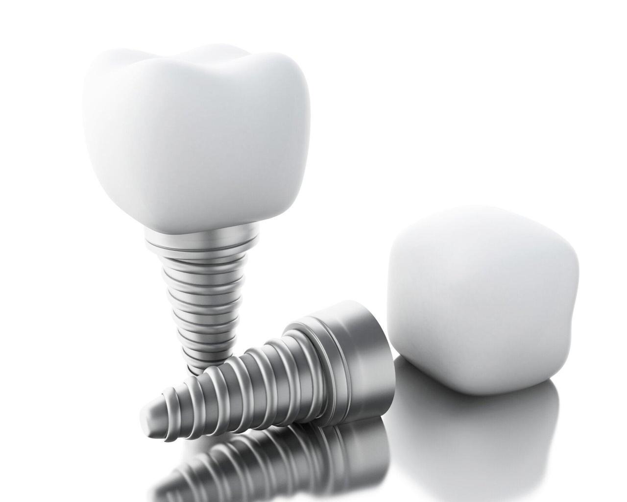 Essential Health Gains from Opting for Dental Implant Treatments