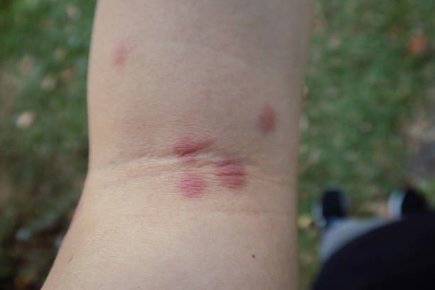 Itchy Bug Bites Ruined My Workdays Until I Found Patches