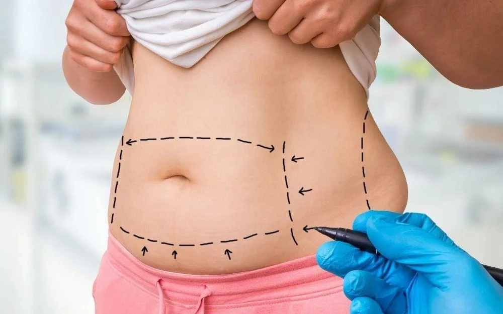 Liposuction What You Should Need to Know About Modren Body Contouring