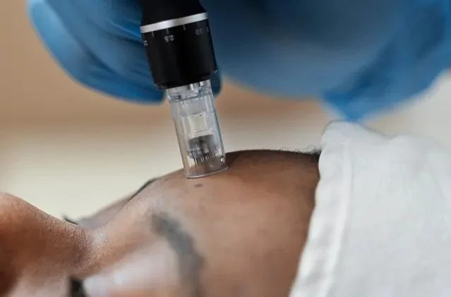 Microneedling Bangalore: Transform Your Skin at a Cosmetic Clinic