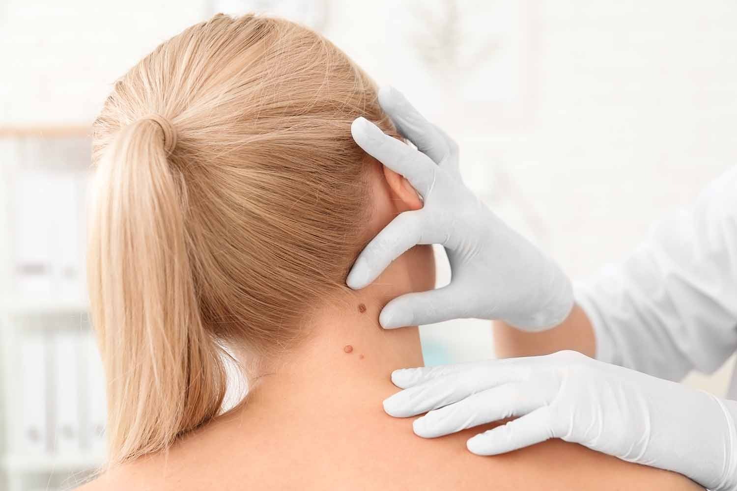 Stay Sun Safe with Skin Check Sunnybank