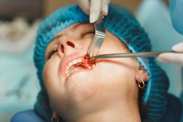 The Best Wisdom Teeth Extraction Company: 7 Trusted Options for Affordable Oral Surgery