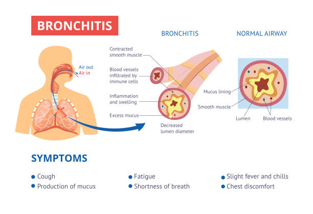The Complete Guide to Evaluating Chronic Bronchitis Symptoms and Progression
