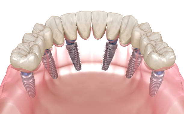 Transform Your Smile with All-on-4 Dental Implants