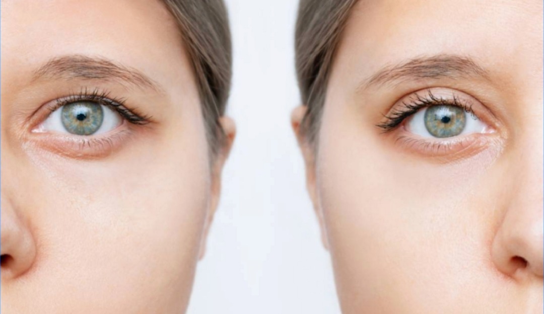 Upper vs Lower Blepharoplasty: Which Procedure Is Right for You