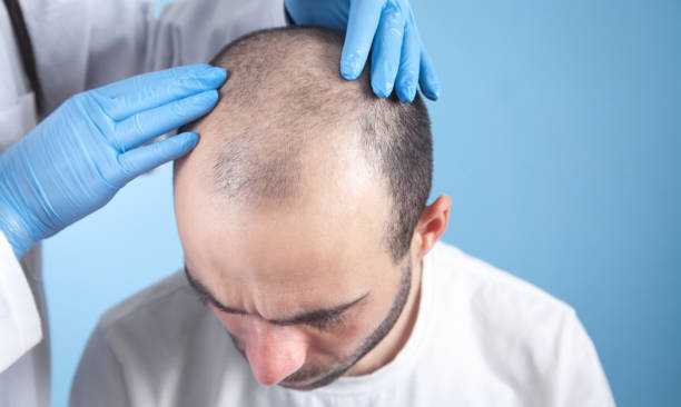 What Makes FUE Hair Transplants So Popular in Brighton