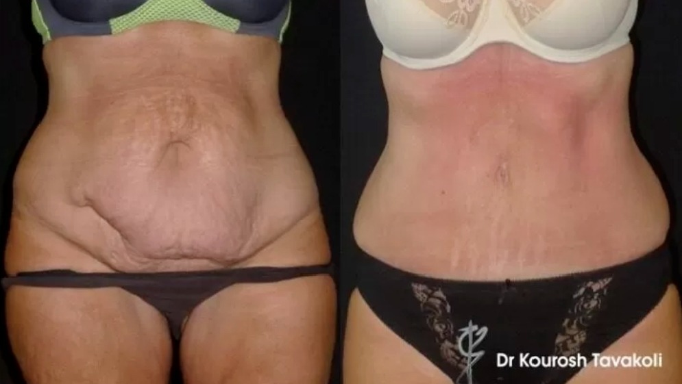 What to Expect From Abdominoplasty (Tummy Tuck) With Dr Tavakoli in Sydney