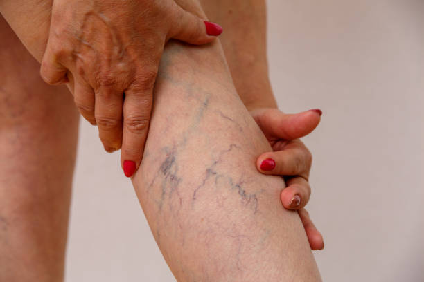 When Vein Treatment Becomes Medically Necessary