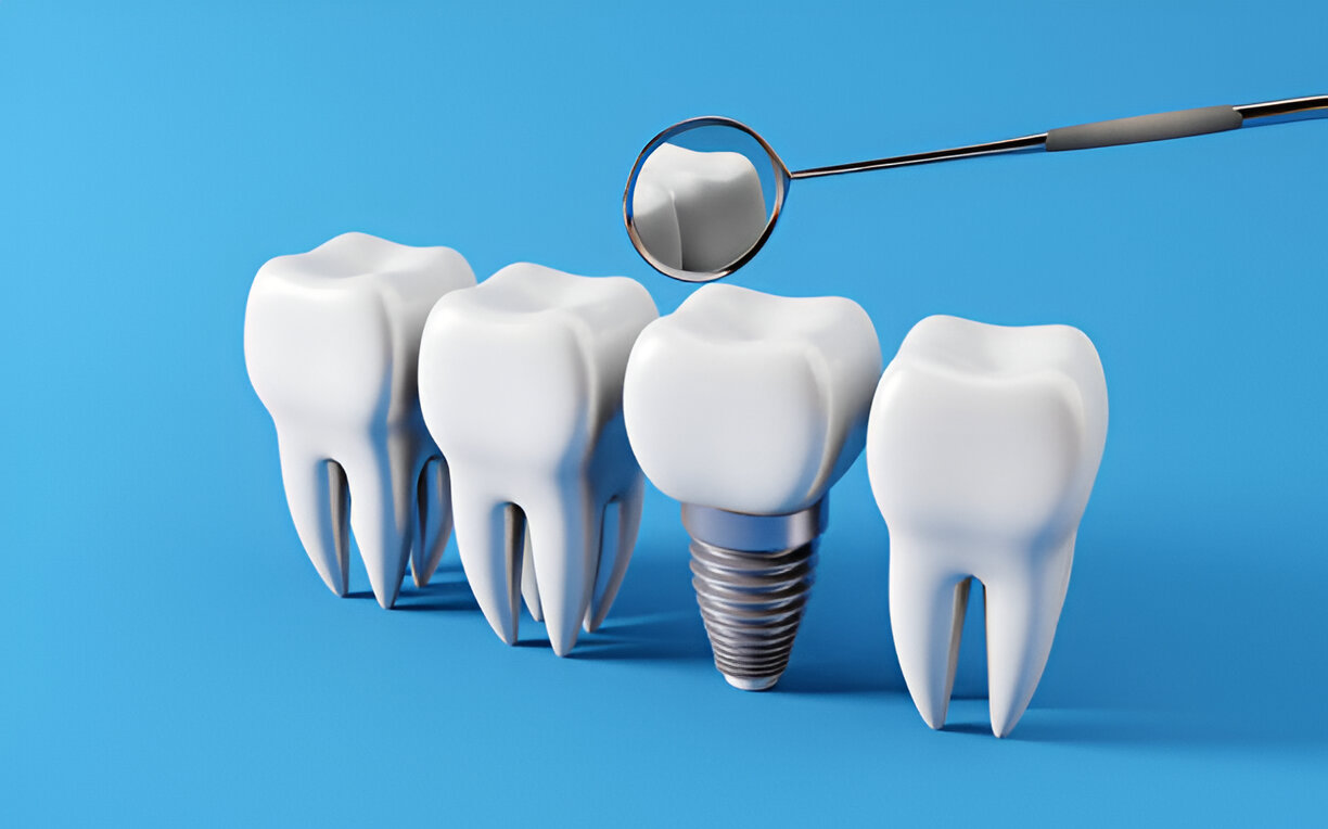 Why Dental Implants Might Be the Best Long-Term Solution in Edison for Missing Teeth